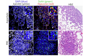 Nature：癌癥轉(zhuǎn)移時為何青睞肺部？