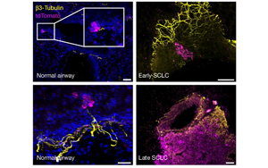 癌細胞會放電？Nature揭示小細胞肺癌擴散新機制