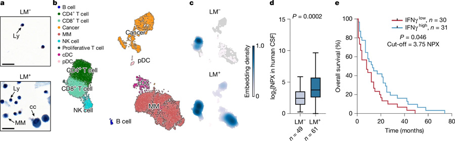  炎癥誘導的腦脊液細胞增多見于軟腦膜轉(zhuǎn)移患者