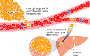 Nature Medicine一項(xiàng)開創(chuàng)性的新研究可防止乳腺癌復(fù)發(fā)