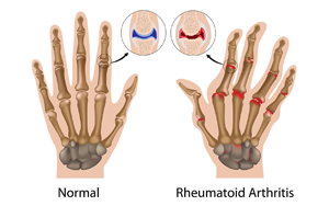 中性粒細胞與白蛋白比率（NPAR）：類風濕關節(jié)炎骨質(zhì)疏松風險的新型預測因子及其臨床轉(zhuǎn)化價值