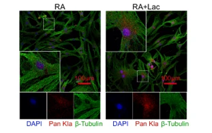 組蛋白乳酸化修飾通過上調NFATc2表達及抗乳酸化組蛋白自身抗體促進類風濕關節(jié)炎進展