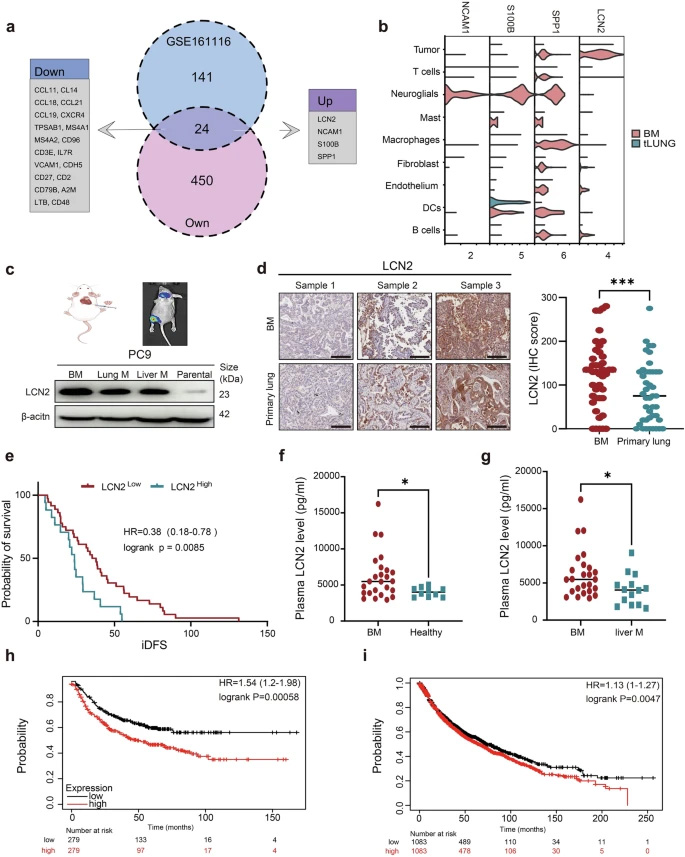 LCN2在腦轉(zhuǎn)移組織中過表達(dá)，且與肺癌患者的不良預(yù)后相關(guān)