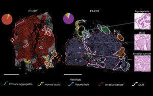 Nature：利用空間基因組學(xué)來(lái)了解乳腺癌克隆如何進(jìn)化