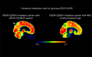 Nature Medicine發(fā)現(xiàn)了新的基因變異，可以預(yù)防阿爾茨海默病