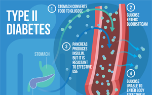 Nature Medicine：2型糖尿病的多祖先多基因機制
